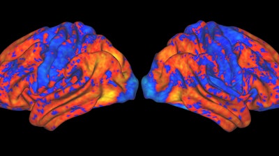 Psychiatry professor Hugh Garavan’s NIH-funded research uses brain scans like the ones above to determine the impact of drugs and alcohol on brain development in youth. The VACC upgrade will greatly facilitate this work.