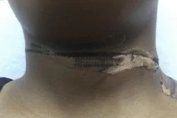 A 19-year old woman was injured when the end of a charger touched her necklace, transmitting electric current and causing second degree burns.