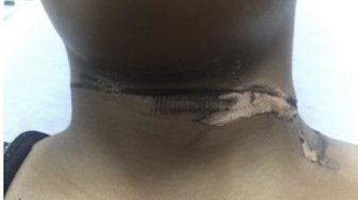 A 19-year old woman was injured when the end of a charger touched her necklace, transmitting electric current and causing second degree burns.