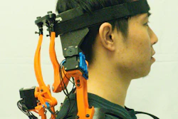 A study participant wearing the robotic neck brace that dramatically improves functions of ALS patients. The comfortable brace incorporates both sensors and actuators to restore roughly 70% of the active range of motion.
