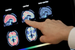 In this Aug. 14, 2018, file photo, Dr. William Burke goes over a PET brain scan at Banner Alzheimers Institute in Phoenix.