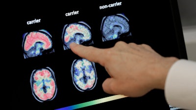 In this Aug. 14, 2018, file photo, Dr. William Burke goes over a PET brain scan at Banner Alzheimers Institute in Phoenix.