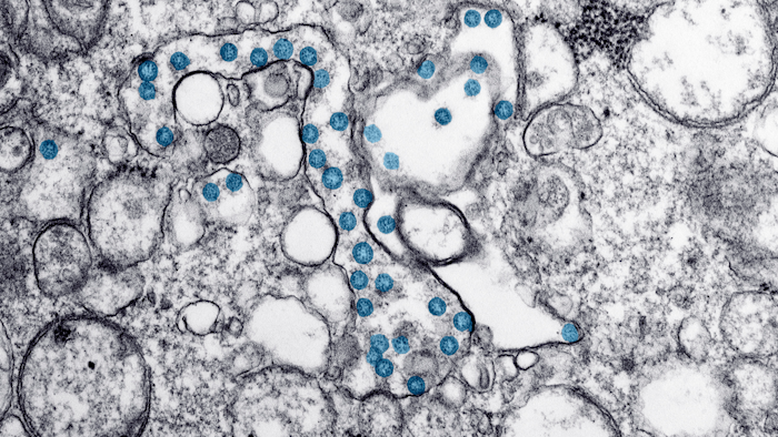 Electron microscope image showing particles of the new coronavirus, colorized blue, from the first U.S. case of COVID-19.