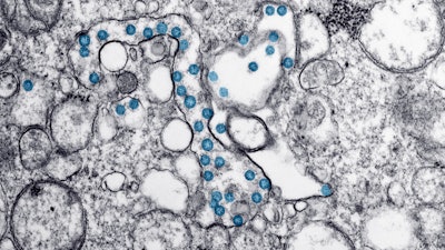 Electron microscope image showing particles of the new coronavirus, colorized blue, from the first U.S. case of COVID-19.