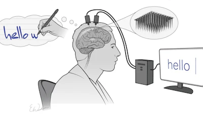 Two implanted electrode arrays record the brain activity produced by thinking about writing letters. This information is then collected and processed in real-time by a computer, which converts that data into words on a screen.