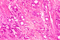 1974 microscope image showing changes in cells indicative of adenocarcinoma of the prostate.