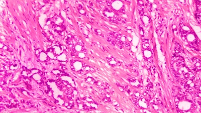 1974 microscope image showing changes in cells indicative of adenocarcinoma of the prostate.