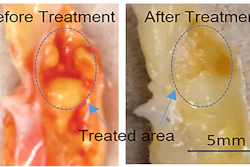 Atherosclerosis, a buildup of plaque, can lead to heart disease, artery disease, and chronic kidney disease and is traditionally treated by inserting and inflating a balloon to expand the artery.