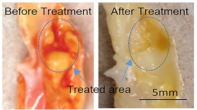 Atherosclerosis, a buildup of plaque, can lead to heart disease, artery disease, and chronic kidney disease and is traditionally treated by inserting and inflating a balloon to expand the artery.