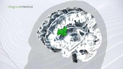 Magnus Brain Image Highlighting Saint Neuromodulation