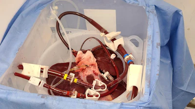 This photo provided by eGenesis on Jan. 18, 2024 shows a genetically modified pig liver in Massachusetts before transportation to the University of Pennsylvania in Philadelphia in December 2023.