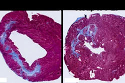 Side by side comparison of heart muscle cells with and without treatment. Damage to the cells is shown in blue. On the left, tissue has been injected with saline and the damaged area is considerably larger. On the right, the issue was treated with the PLP platform and the damaged area is significantly smaller.