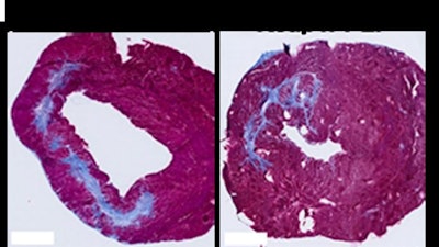 Side by side comparison of heart muscle cells with and without treatment. Damage to the cells is shown in blue. On the left, tissue has been injected with saline and the damaged area is considerably larger. On the right, the issue was treated with the PLP platform and the damaged area is significantly smaller.