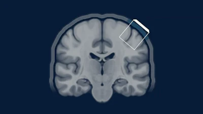 Coronal MRI brain scan showing anatomical structures with a smartphone icon overlay on the upper right