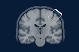 Coronal MRI brain scan showing anatomical structures with a smartphone icon overlay on the upper right