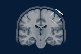 Coronal MRI brain scan showing anatomical structures with a smartphone icon overlay on the upper right